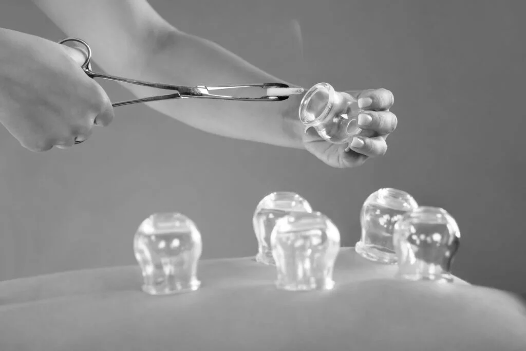 cupping therapy union nj 1024x683 2